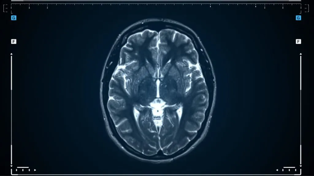 How Does Functional Medicine Treat Seizures: Revealing the Secret Mechanisms